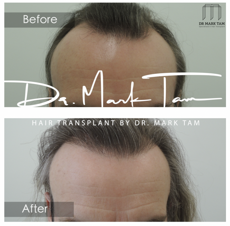 Hair Transplant by Dr Mark Tam, London