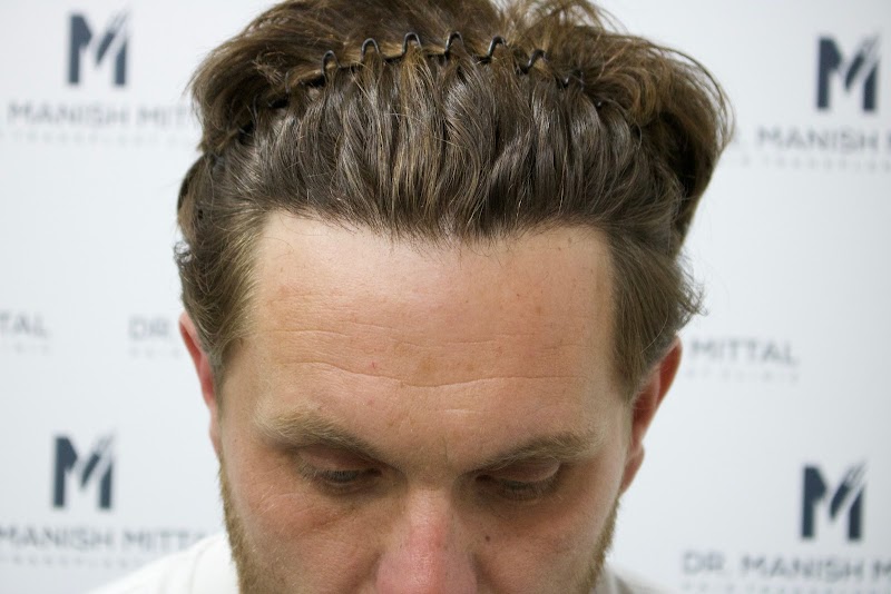 Mittal Hair Clinic, London